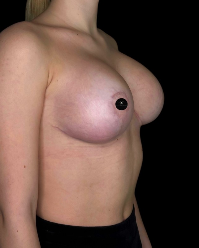 Mammoplasty
