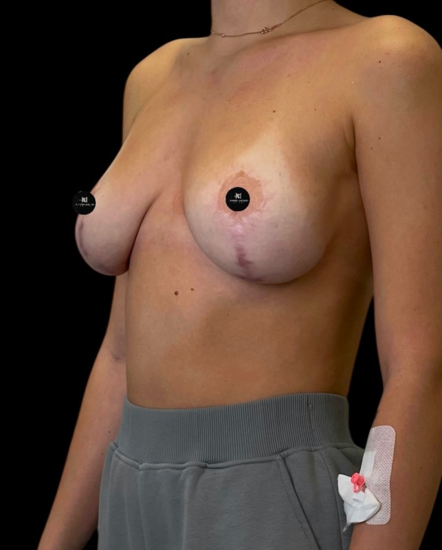 Mammoplasty