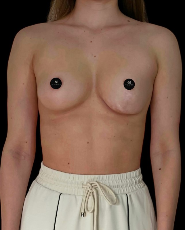Mammoplasty