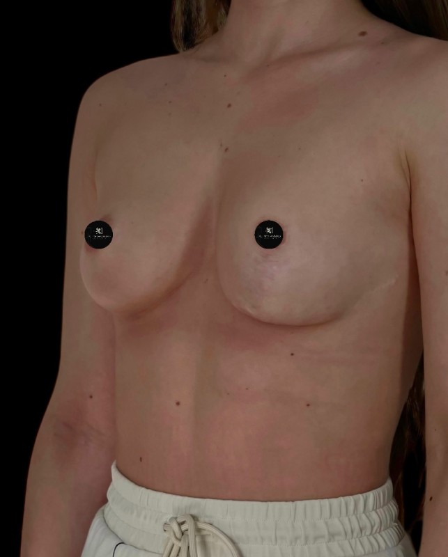 Mammoplasty