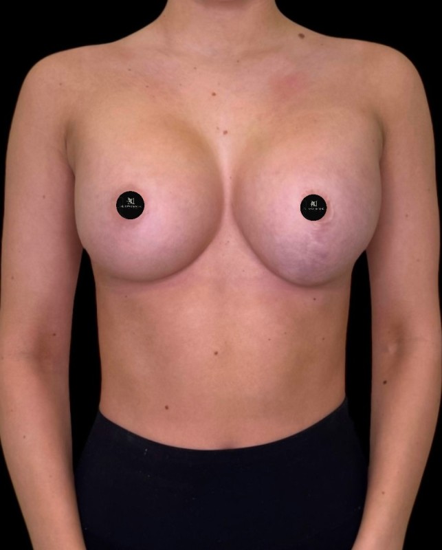 Mammoplasty