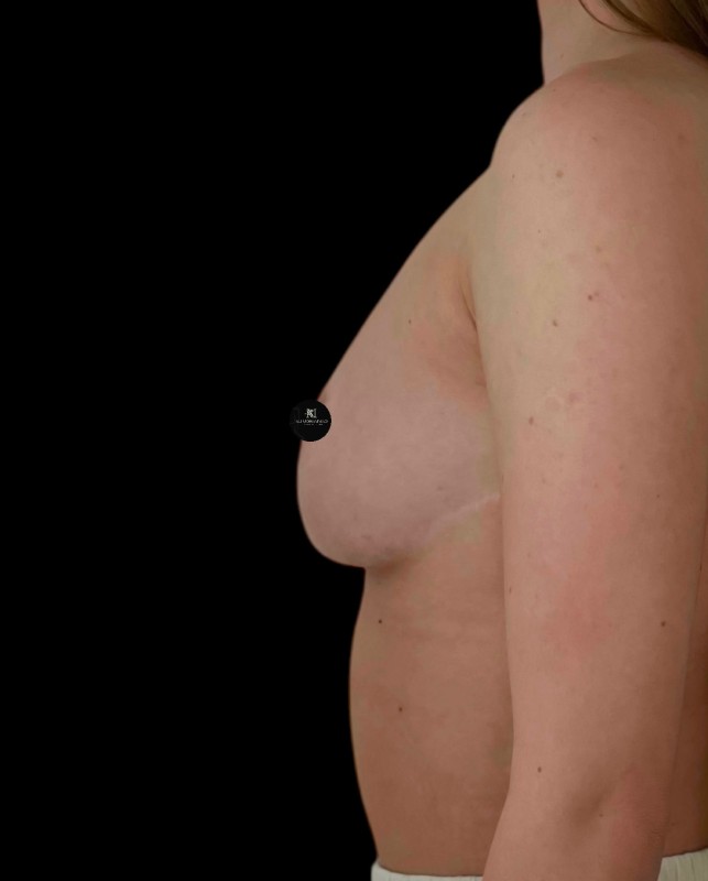 Mammoplasty