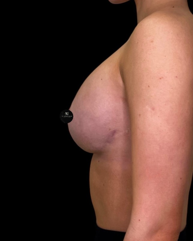 Mammoplasty