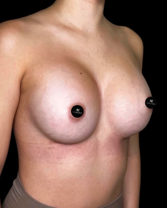 Mammoplasty