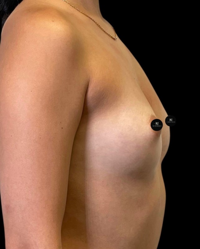 Mammoplasty