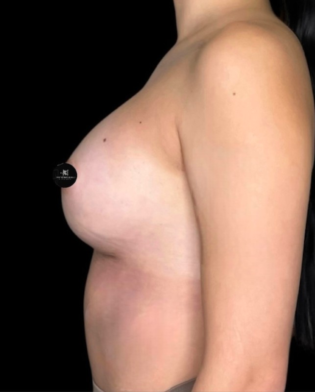 Mammoplasty