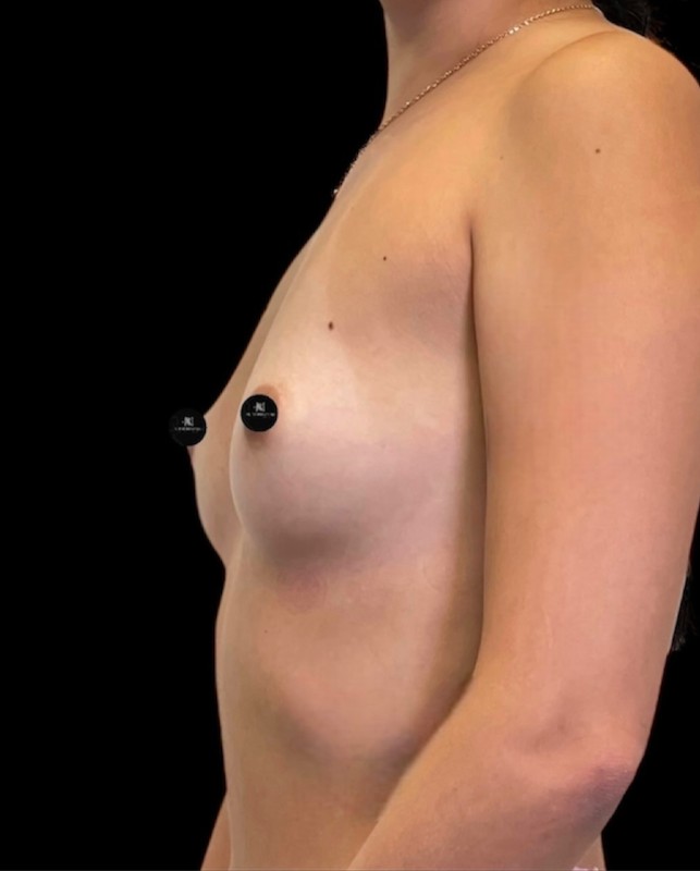 Mammoplasty