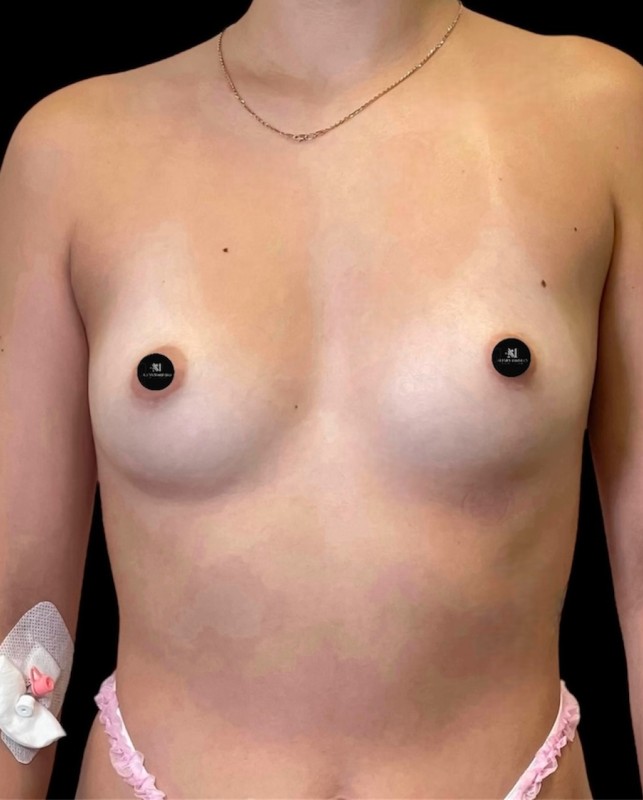 Mammoplasty