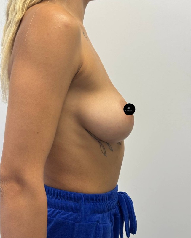 Mammoplasty