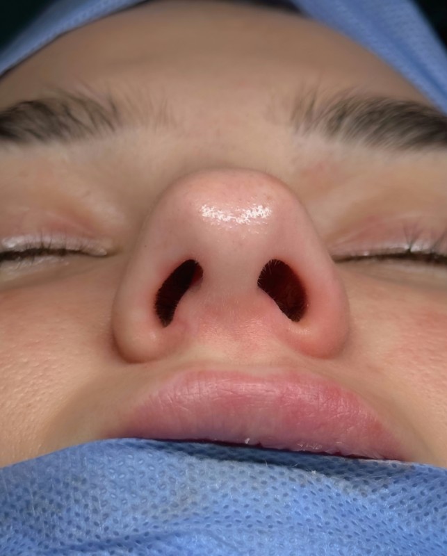 renoplastic