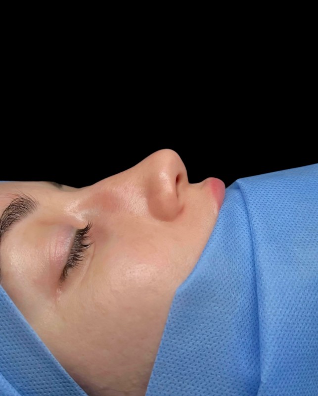 renoplastic