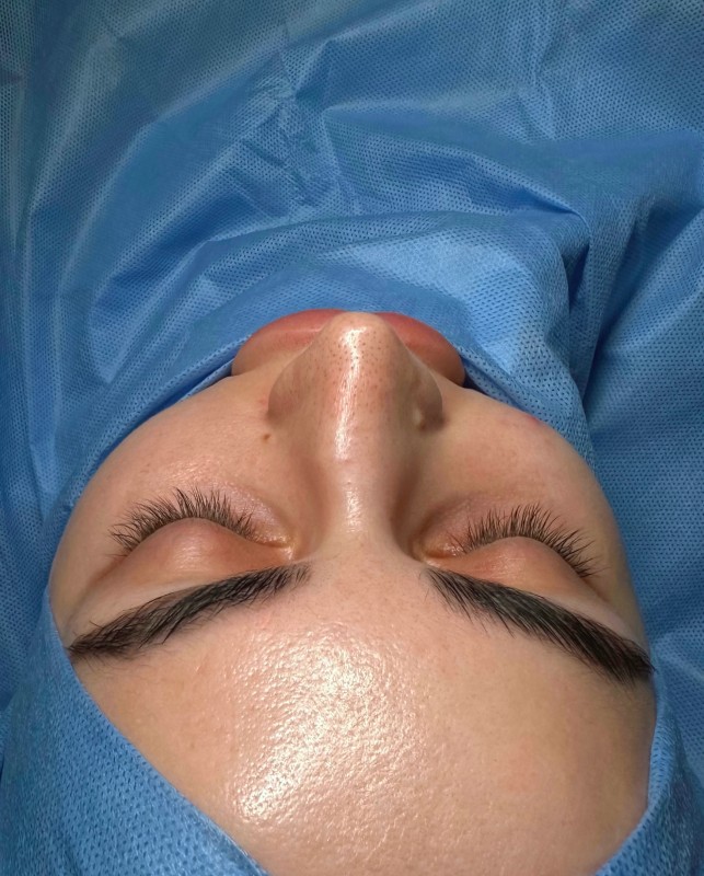 renoplastic