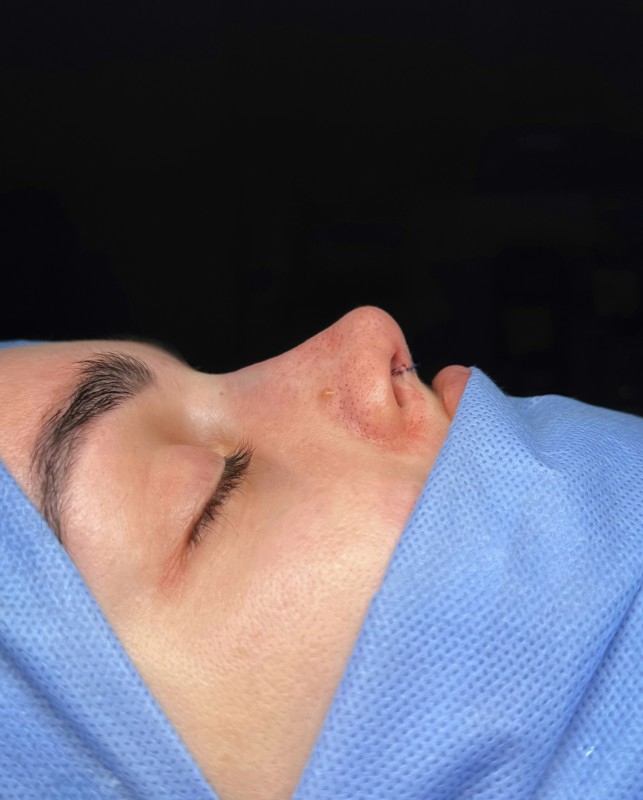 renoplastic