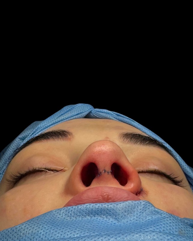 renoplastic