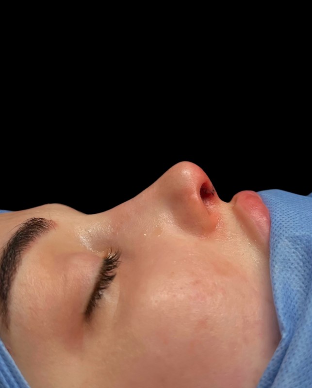 renoplastic