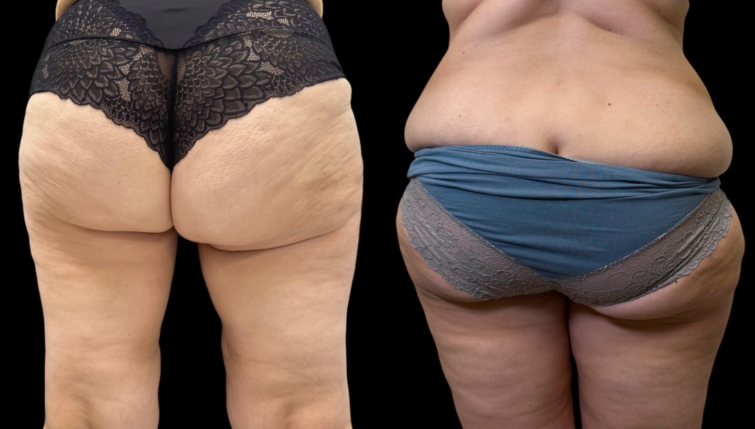 before after