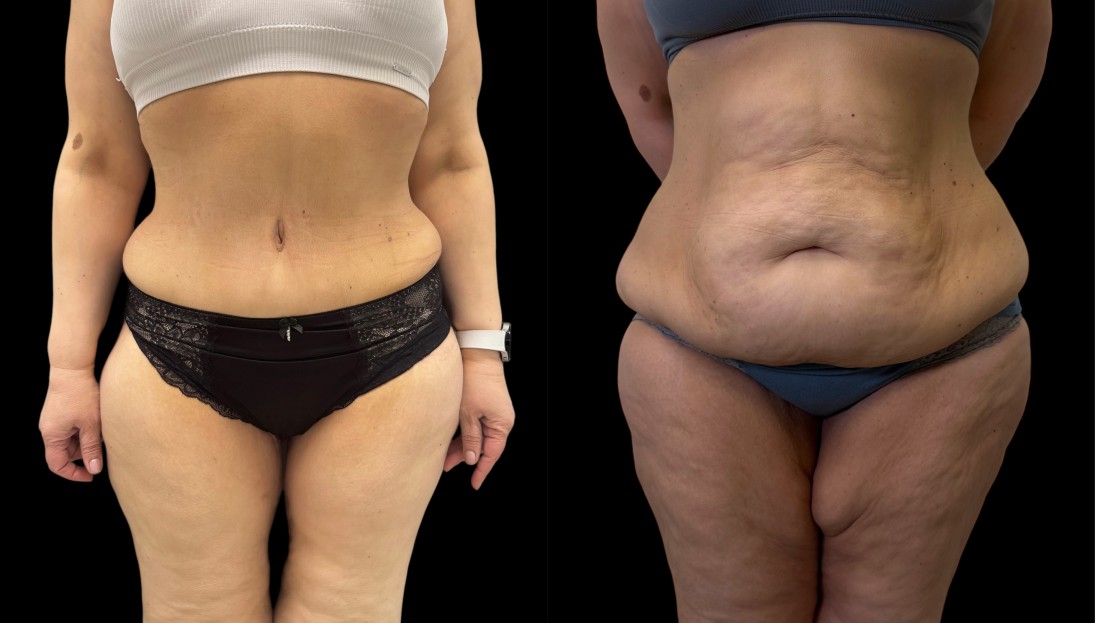 before after