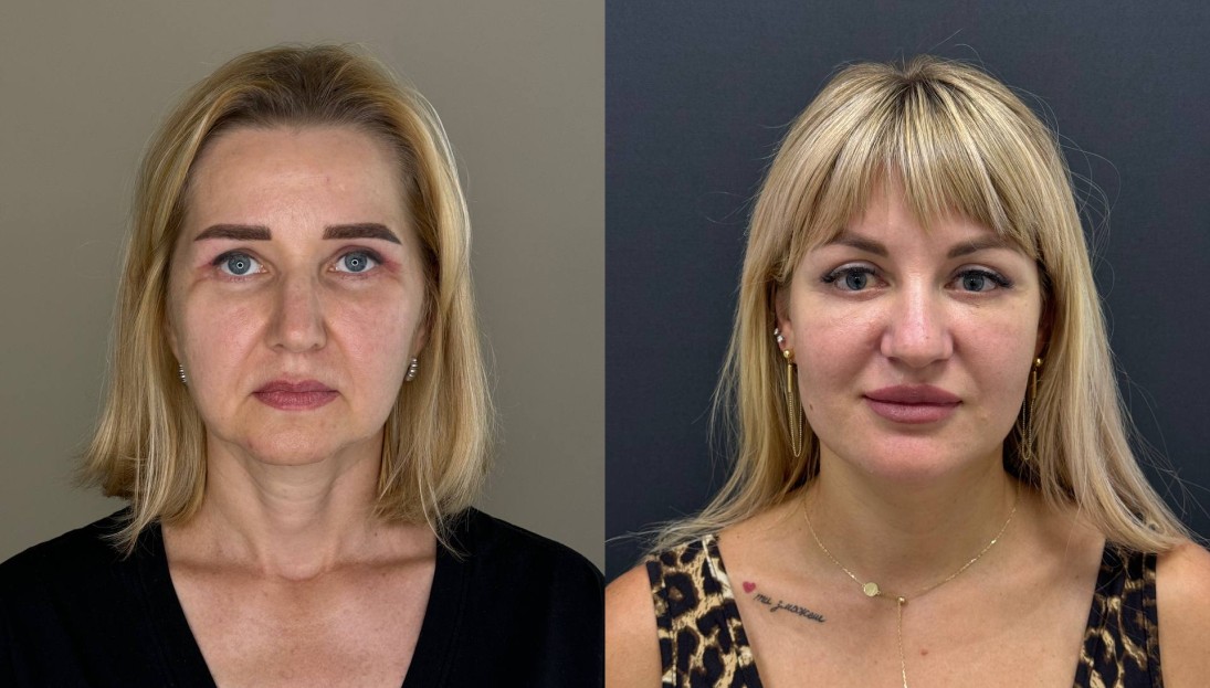 before after